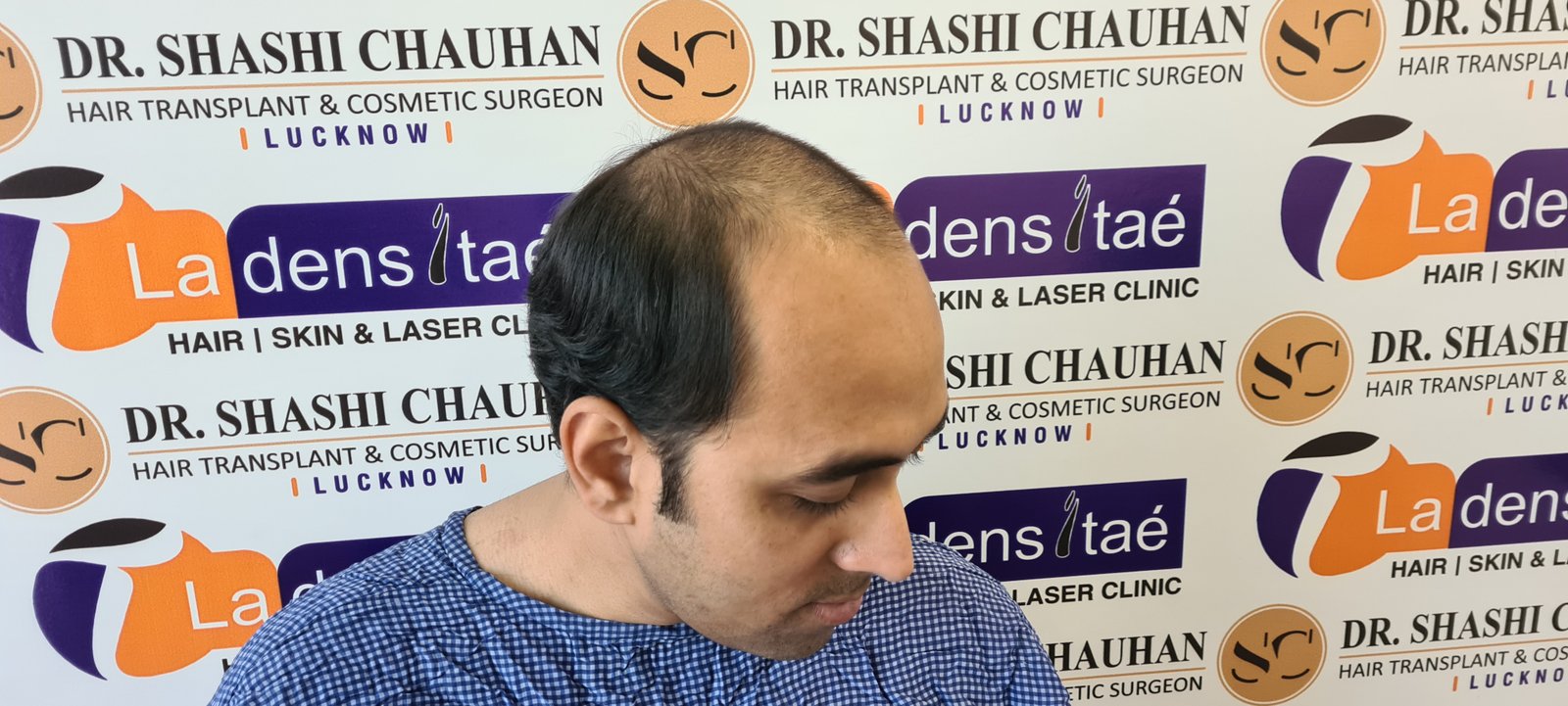 Utsav Aman Before Hair Transplant